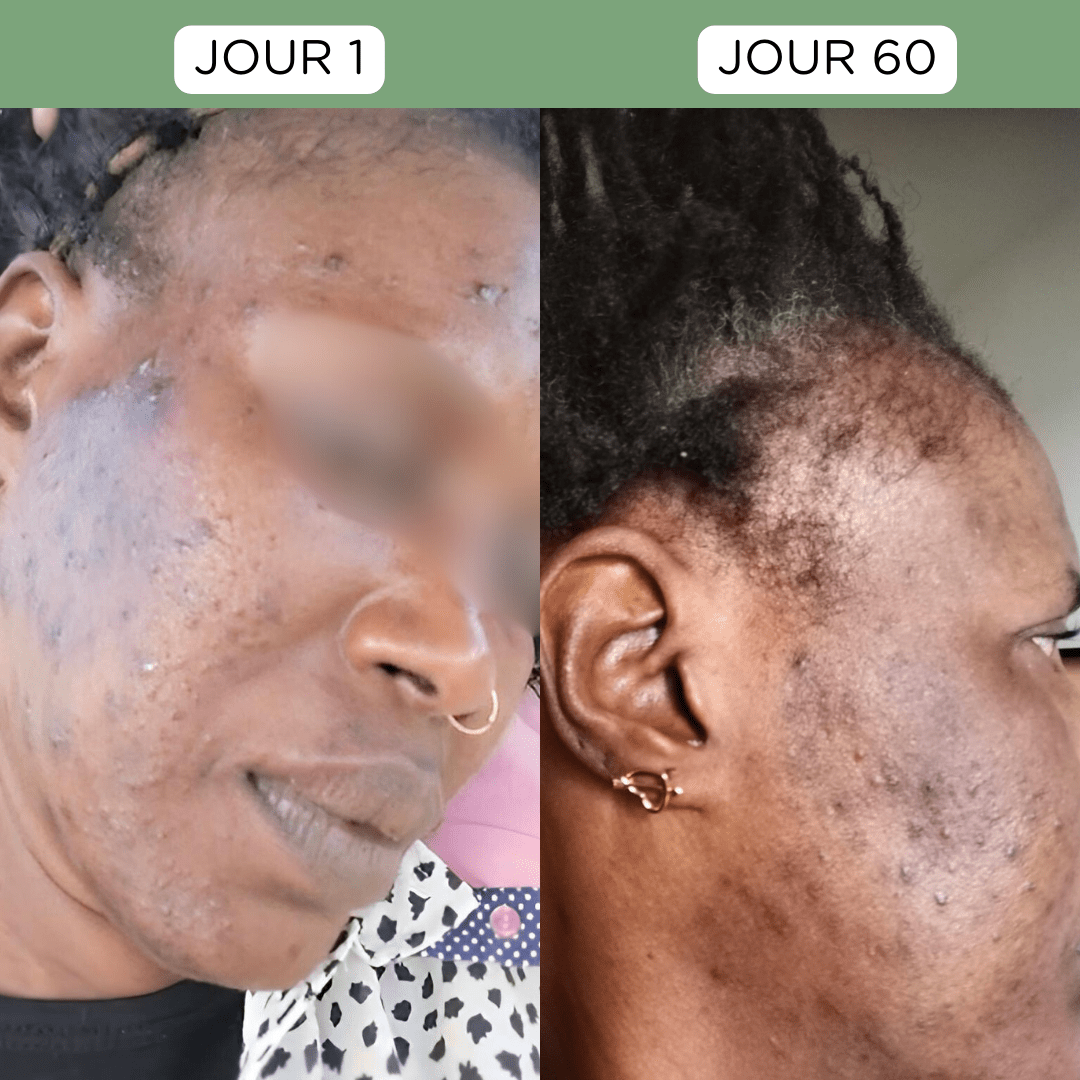 Comprendre l'Hyperpigmentation: Causes et Solutions pour Peaux Noires - MUSSOFI