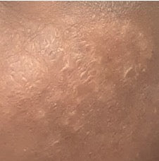 Peau fragilisée avant